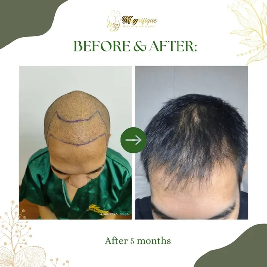 Scalp with the hairline marked on surgery day, and the same crown with new growth 5 months later