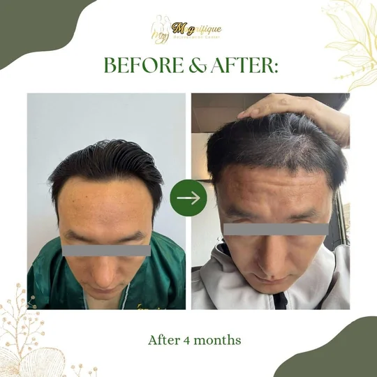 Before and after FUE hair transplant at Magnifique: a receding hairline, then fuller growth 4 months on