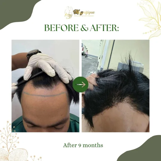 Nine months after FUE at Magnifique, the marked hairline has filled in