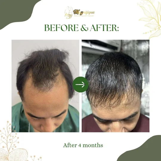 FUE result after 4 months: temples that were bare now carry hair