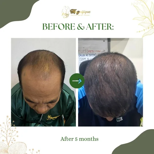 Thinning across the top before FUE, then thicker coverage after 5 months